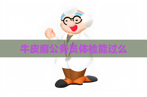 牛皮癣公务员体检能过么